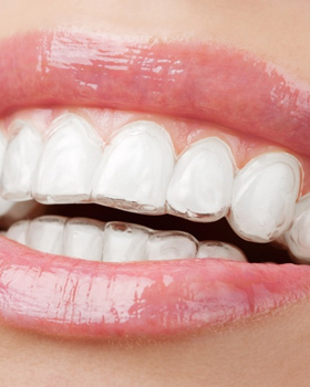 Invisible Braces